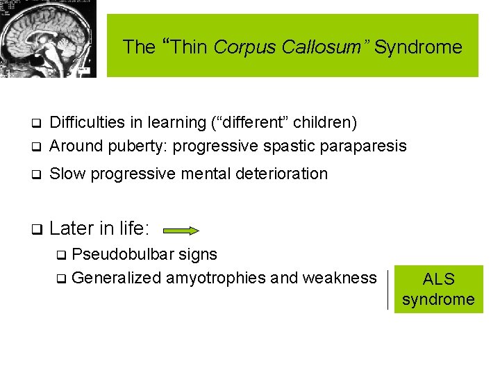 The “Thin Corpus Callosum” Syndrome q Difficulties in learning (“different” children) Around puberty: progressive