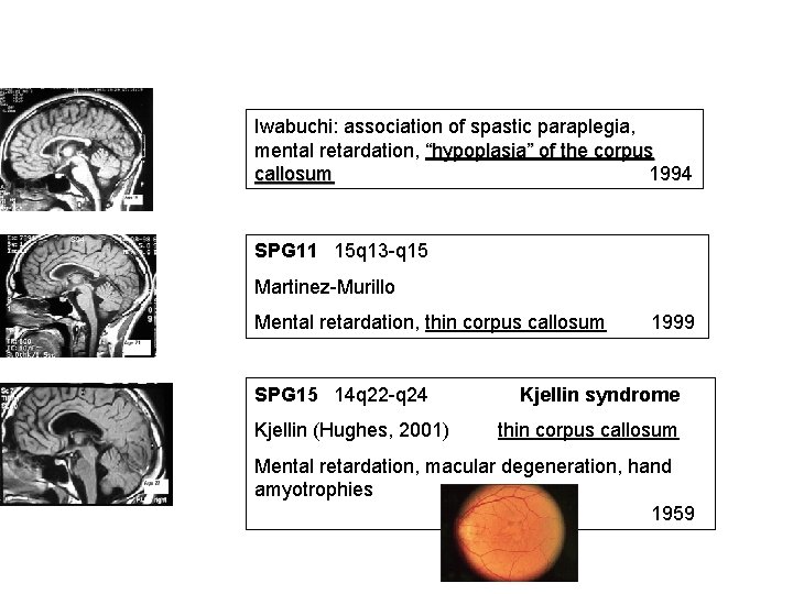 Iwabuchi: association of spastic paraplegia, mental retardation, “hypoplasia” of the corpus callosum 1994 SPG Iwabuchi: association of spastic paraplegia, mental retardation, “hypoplasia” of the corpus callosum 1994 SPG