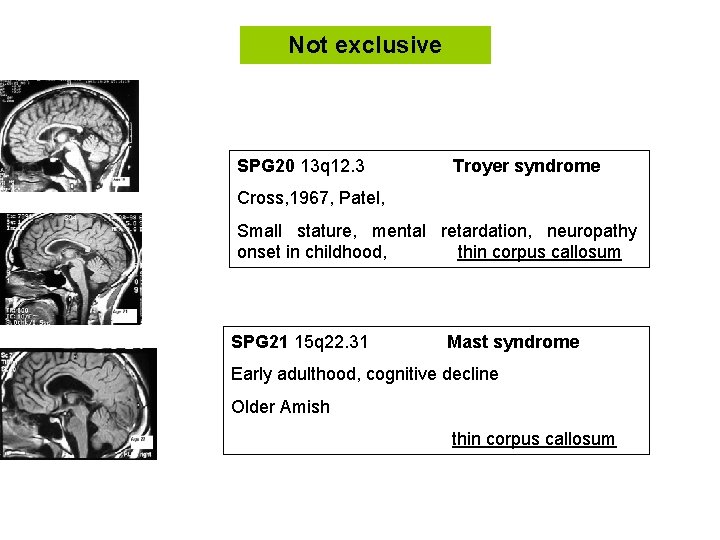 Not exclusive SPG 20 13 q 12. 3 Troyer syndrome Cross, 1967, Patel, Small