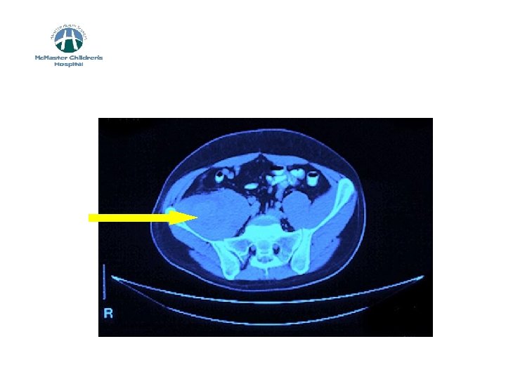 CT of Pelvis 