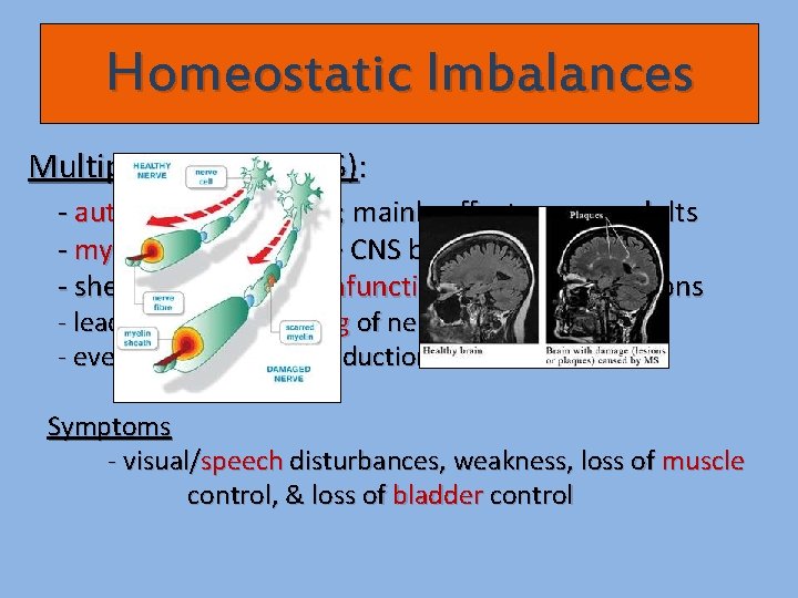 Homeostatic Imbalances Multiple Sclerosis (MS): - autoimmune disease; mainly affects young adults - myelin