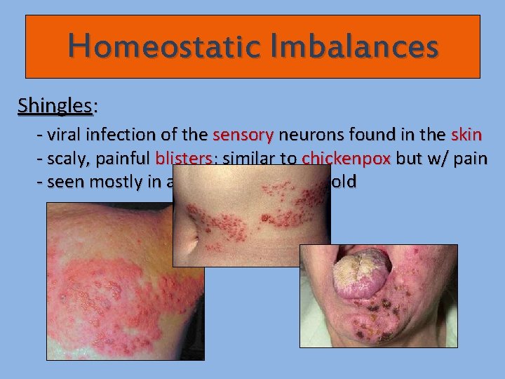 Homeostatic Imbalances Shingles: - viral infection of the sensory neurons found in the skin