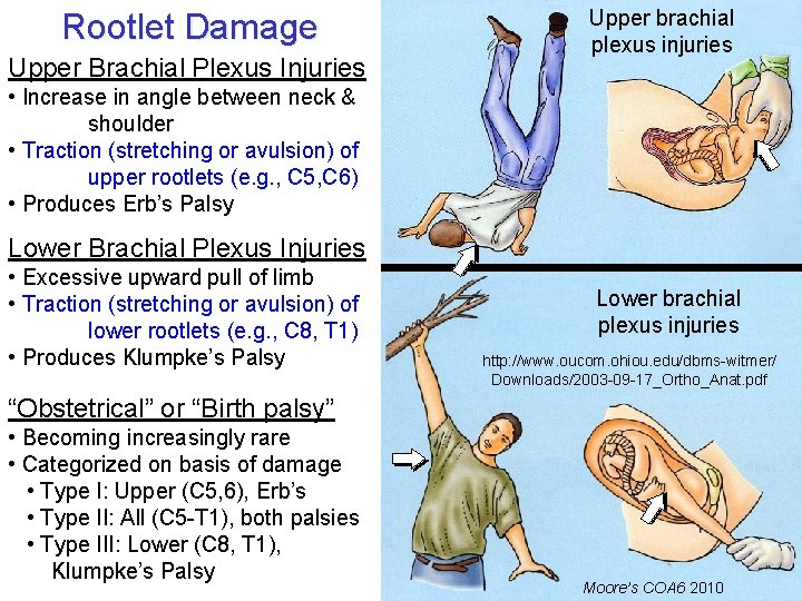 Rootlet Damage Upper Brachial Plexus Injuries Upper brachial plexus injuries • Increase in angle