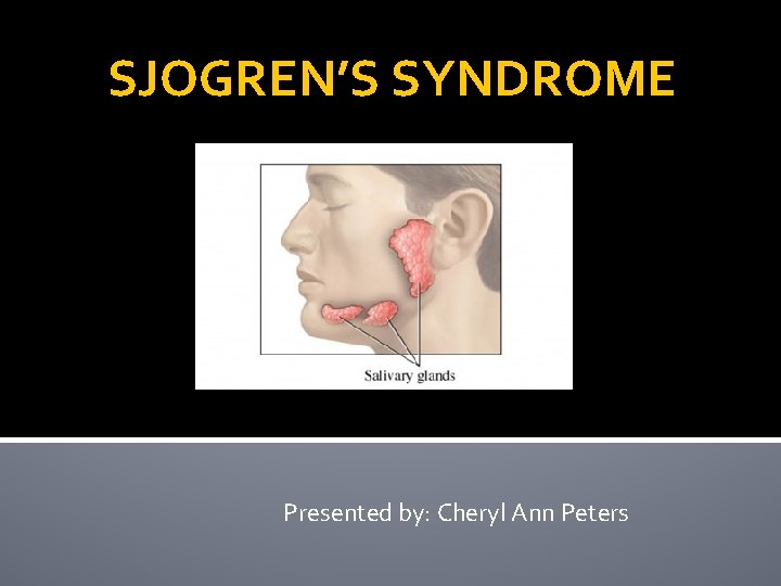 SJOGREN’S SYNDROME Presented by: Cheryl Ann Peters 