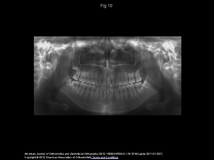 Fig 10 American Journal of Orthodontics and Dentofacial Orthopedics 2012 142524 -533 DOI: (10.