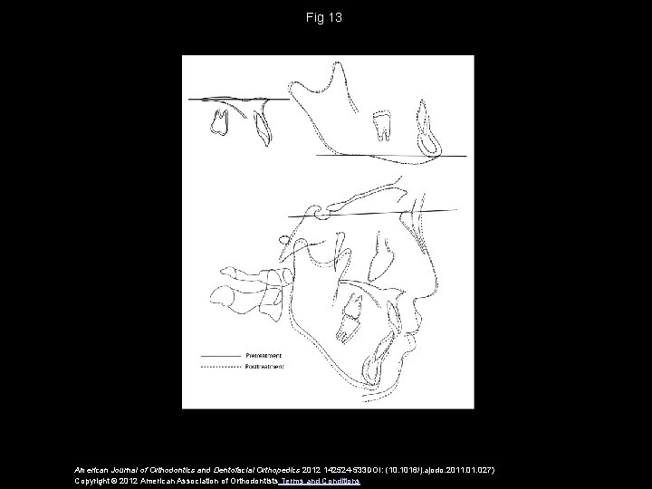 Fig 13 American Journal of Orthodontics and Dentofacial Orthopedics 2012 142524 -533 DOI: (10.