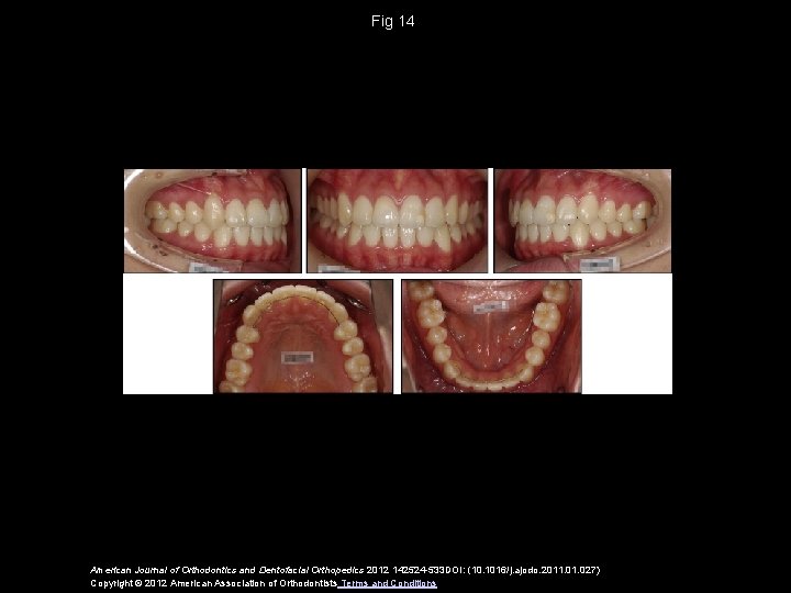 Fig 14 American Journal of Orthodontics and Dentofacial Orthopedics 2012 142524 -533 DOI: (10.