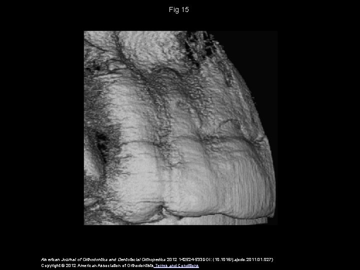 Fig 15 American Journal of Orthodontics and Dentofacial Orthopedics 2012 142524 -533 DOI: (10.