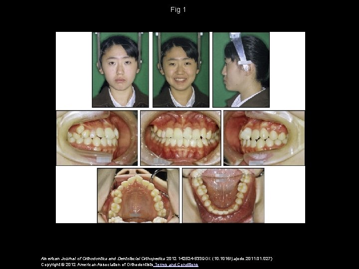 Fig 1 American Journal of Orthodontics and Dentofacial Orthopedics 2012 142524 -533 DOI: (10.