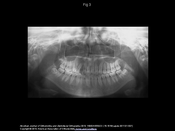 Fig 3 American Journal of Orthodontics and Dentofacial Orthopedics 2012 142524 -533 DOI: (10.