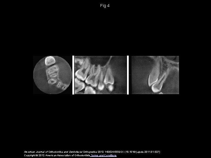 Fig 4 American Journal of Orthodontics and Dentofacial Orthopedics 2012 142524 -533 DOI: (10.