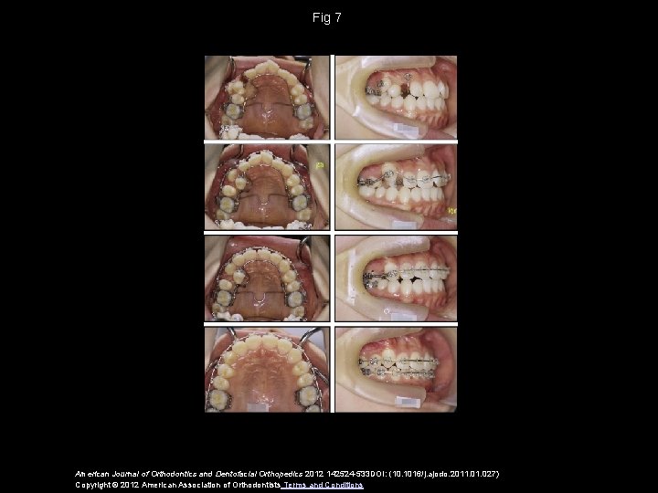 Fig 7 American Journal of Orthodontics and Dentofacial Orthopedics 2012 142524 -533 DOI: (10.