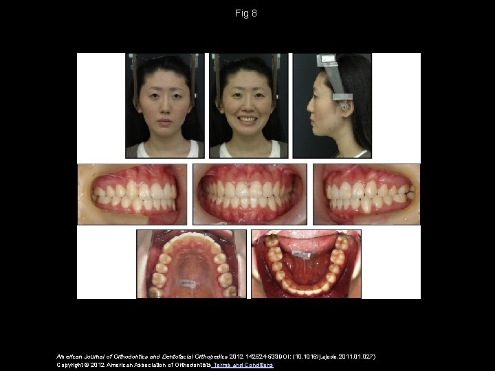 Fig 8 American Journal of Orthodontics and Dentofacial Orthopedics 2012 142524 -533 DOI: (10.