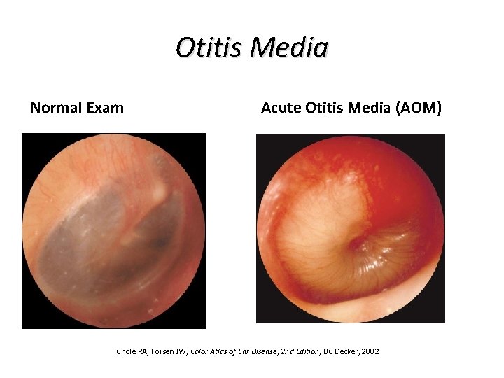 Otitis Media Normal Exam Acute Otitis Media (AOM) Chole RA, Forsen JW, Color Atlas