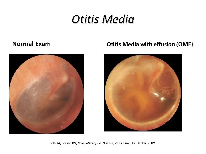 Otitis Media Normal Exam Otitis Media with effusion (OME) Chole RA, Forsen JW, Color