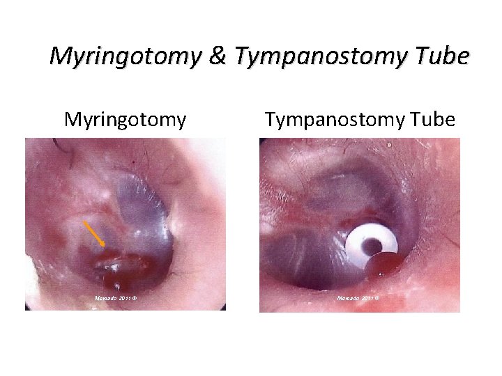 Myringotomy & Tympanostomy Tube Myringotomy Mercado 2011 © Tympanostomy Tube Mercado 2011 © 