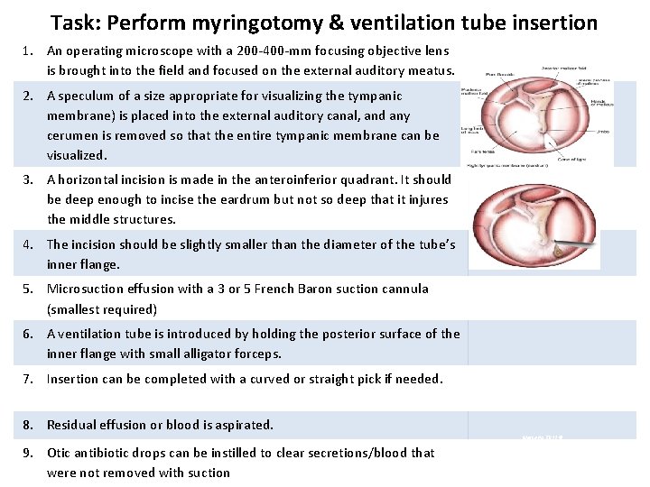 Task: Perform myringotomy & ventilation tube insertion 1. An operating microscope with a 200