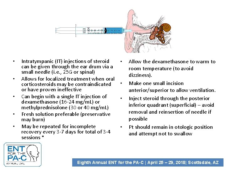  • • • Intratympanic (IT) injections of steroid can be given through the