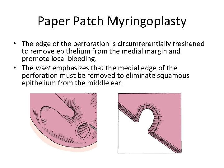 Paper Patch Myringoplasty • The edge of the perforation is circumferentially freshened to remove