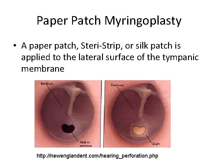 Paper Patch Myringoplasty • A paper patch, Steri-Strip, or silk patch is applied to