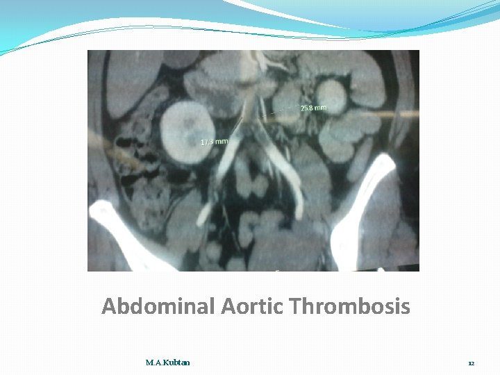 Abdominal Aortic Thrombosis M. A. Kubtan 12 