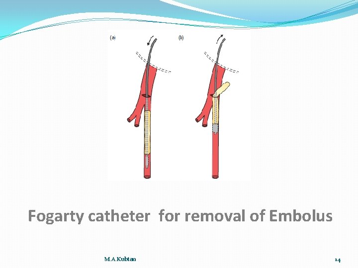 Fogarty catheter for removal of Embolus M. A. Kubtan 14 