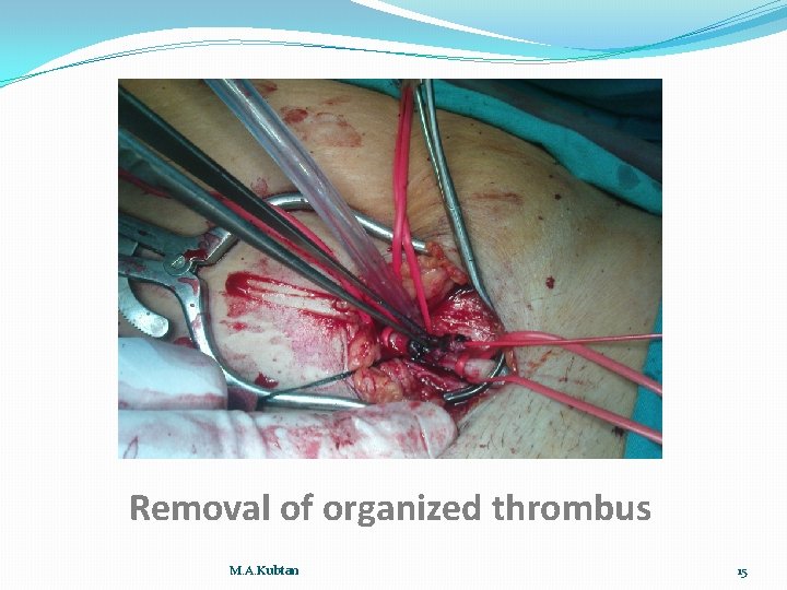 Removal of organized thrombus M. A. Kubtan 15 