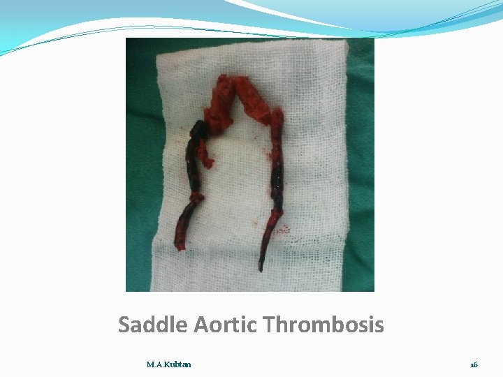 Saddle Aortic Thrombosis M. A. Kubtan 16 