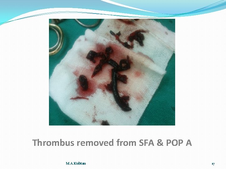 Thrombus removed from SFA & POP A M. A. Kubtan 17 