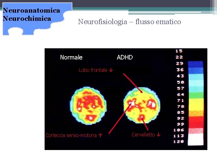 Neuroanatomica Neurochimica Neurofisiologia – flusso ematico Normale ADHD Lobo frontale â Corteccia senso-motoria á