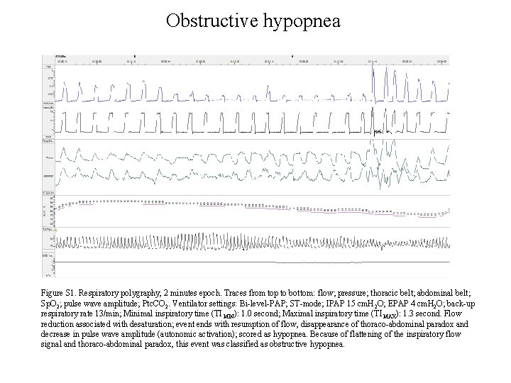 Obstructive hypopnea Figure S 1. Respiratory polygraphy, 2 minutes epoch. Traces from top to