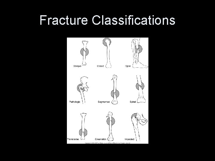 Fracture Classifications 