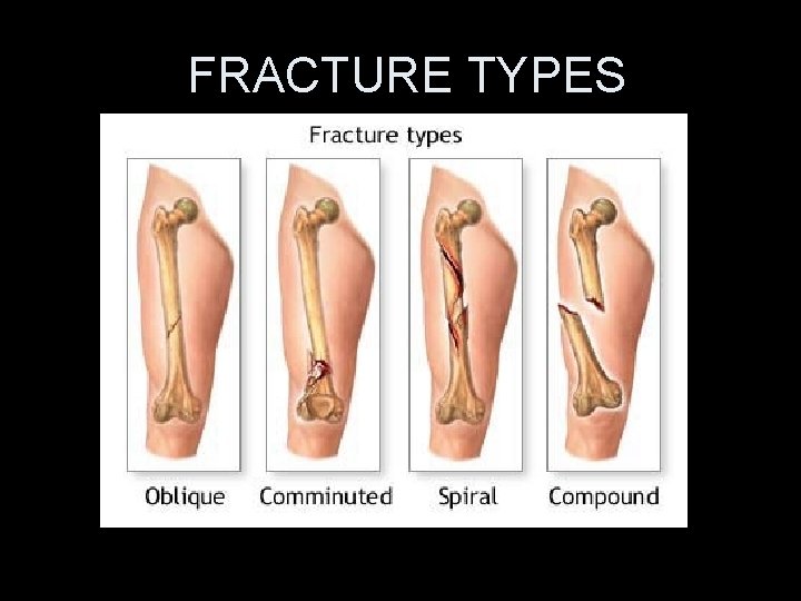 FRACTURE TYPES 