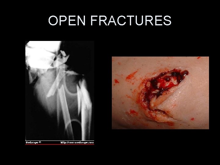 OPEN FRACTURES 