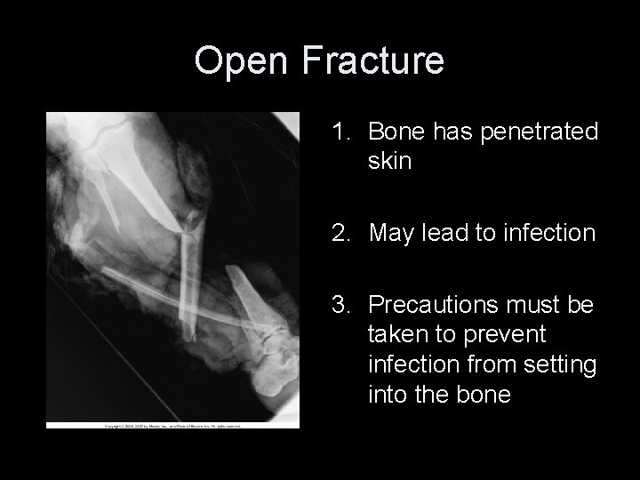 Open Fracture 1. Bone has penetrated skin 2. May lead to infection 3. Precautions