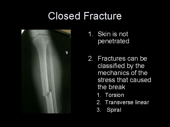 Closed Fracture 1. Skin is not penetrated 2. Fractures can be classified by the