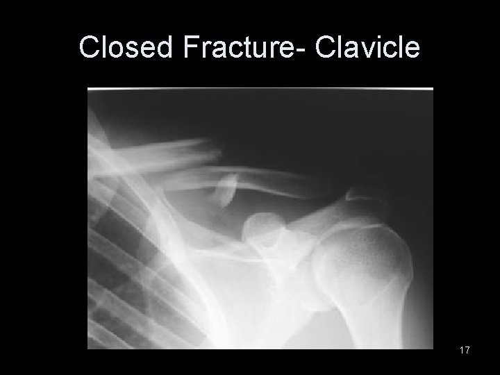 Closed Fracture- Clavicle 17 