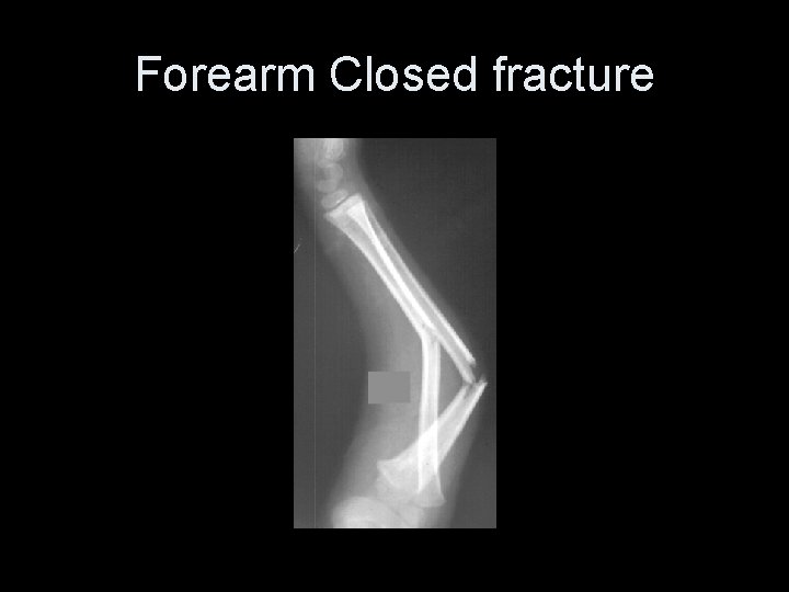 Forearm Closed fracture 