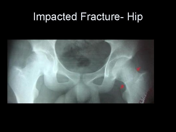 Impacted Fracture- Hip 