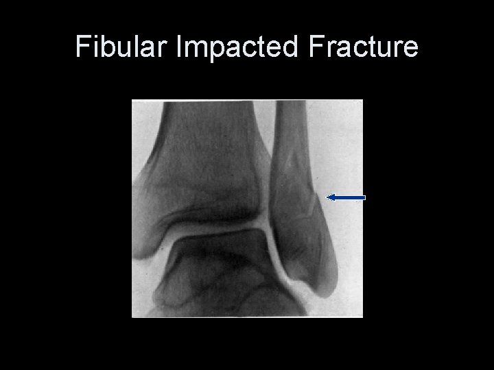 Fibular Impacted Fracture 