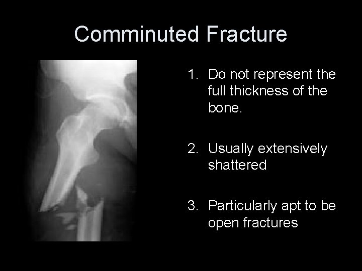 Comminuted Fracture 1. Do not represent the full thickness of the bone. 2. Usually