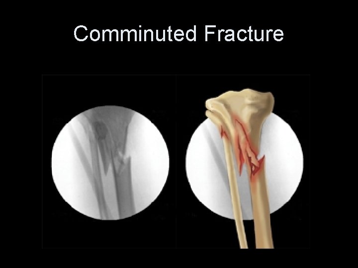 Comminuted Fracture 