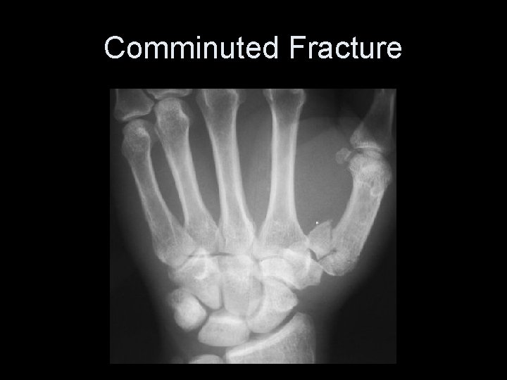 Comminuted Fracture 