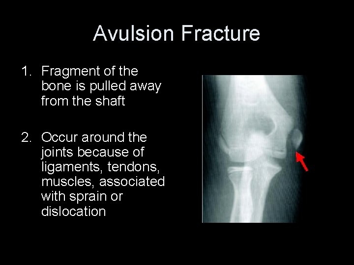 Avulsion Fracture 1. Fragment of the bone is pulled away from the shaft 2.