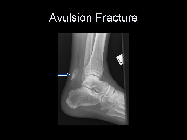 Avulsion Fracture 