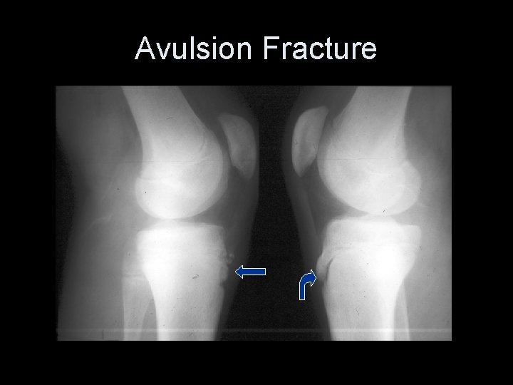 Avulsion Fracture 