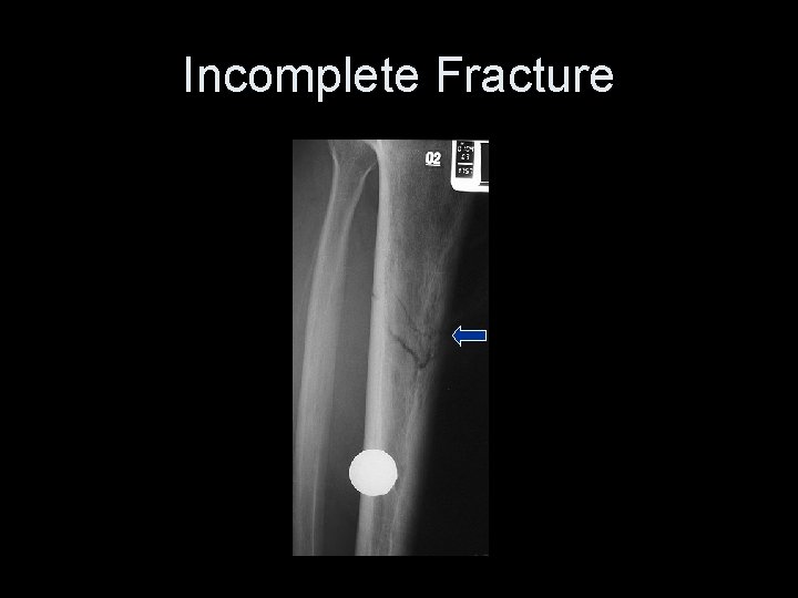 Incomplete Fracture 