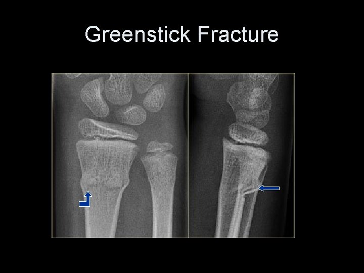 Greenstick Fracture 