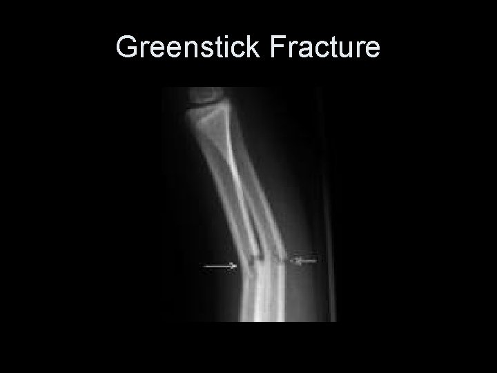 Greenstick Fracture 