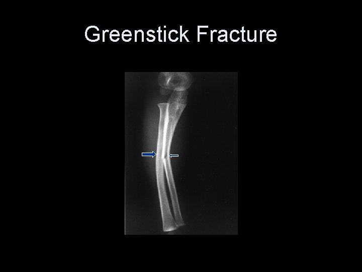 Greenstick Fracture 